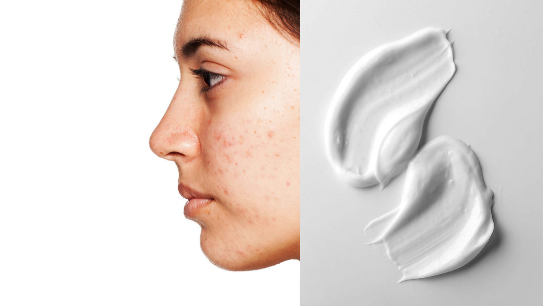 woman with acne looking outward with retinol cream on counter