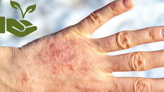 A hand with a skin allergy rash and an icon of a hand with a plant in it